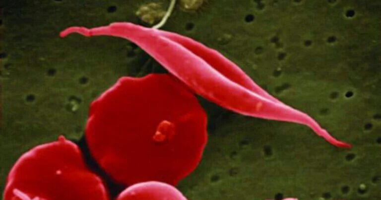 펜실베니아 의료 제공자, 환자들은 약물 회수 후 겸상 적혈구 질환에 대한 새로운 치료 로드맵을 모색합니다.
    


