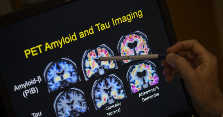 Philly Alzheimer 's Disease 연구원들은 새로운 진단 혈액 검사를 약속하지만주의를 기울여야합니다.
    


